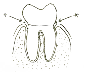 Shows gumlines next to tooth where bacteria are found